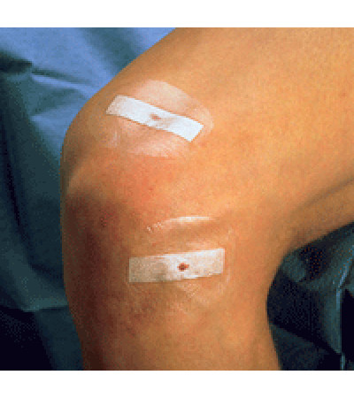 ЗМ™ Steri-Strip™ Wound Closure System - матеріал для безшовного закриття ран